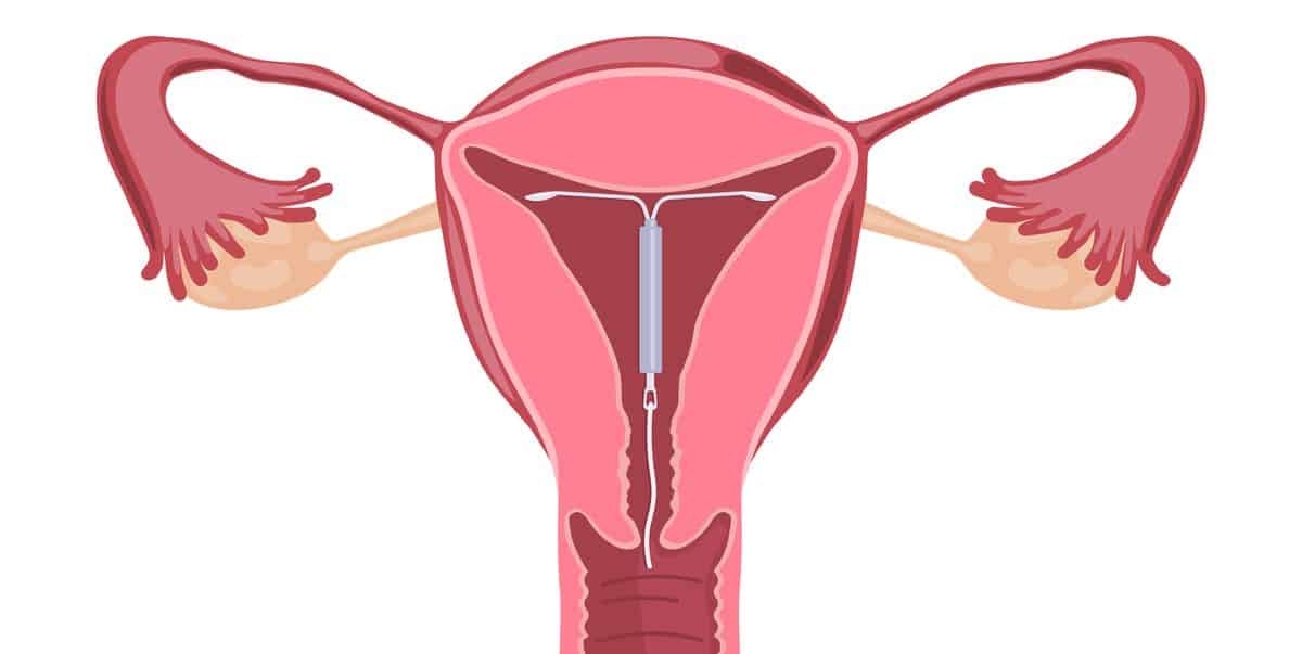 iud uterus