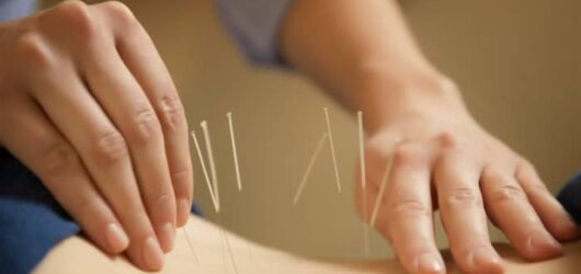 Dry Needling: Pain Relief or Controversial Therapy?